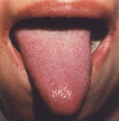 Красный язык при жаре с повреждением жидкостей тела