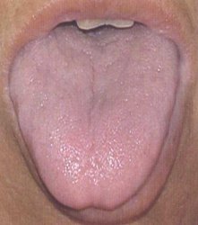 Потрескавшийся светлый язык при недостатке крови